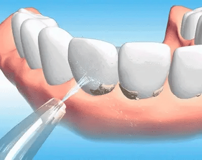 AquaSmile™ Portable Oral Irrigator